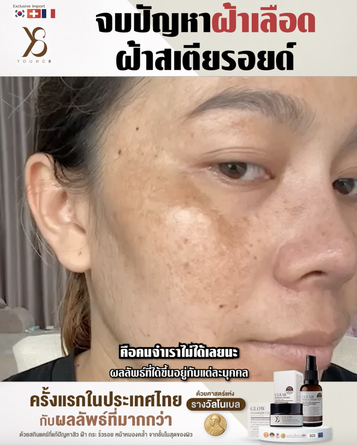 Y8 จัดการฝ้าสเตียรอยด์ได้จริงหรือ